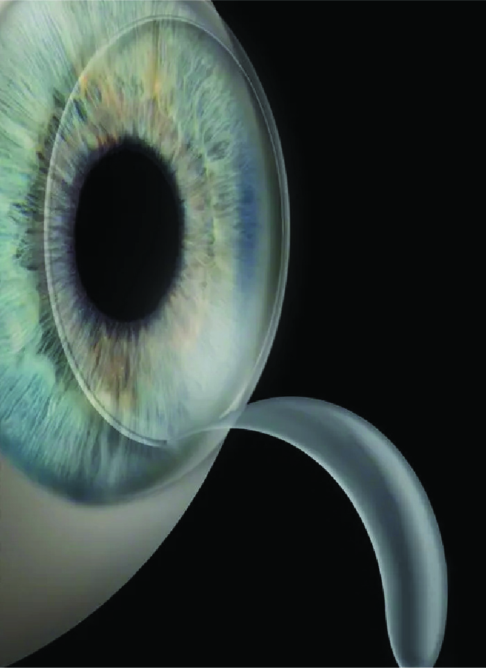 specialty-x-cornea
