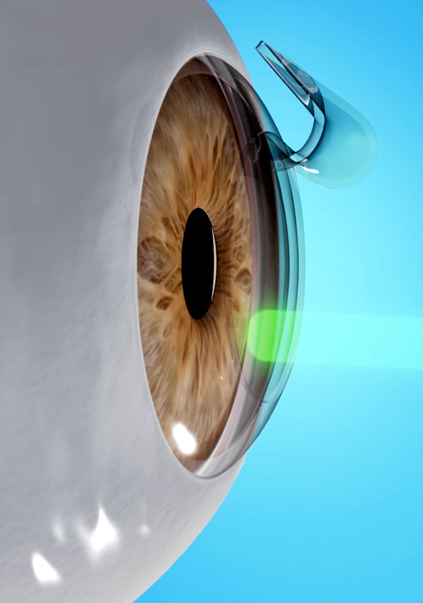 surgery-lasereye