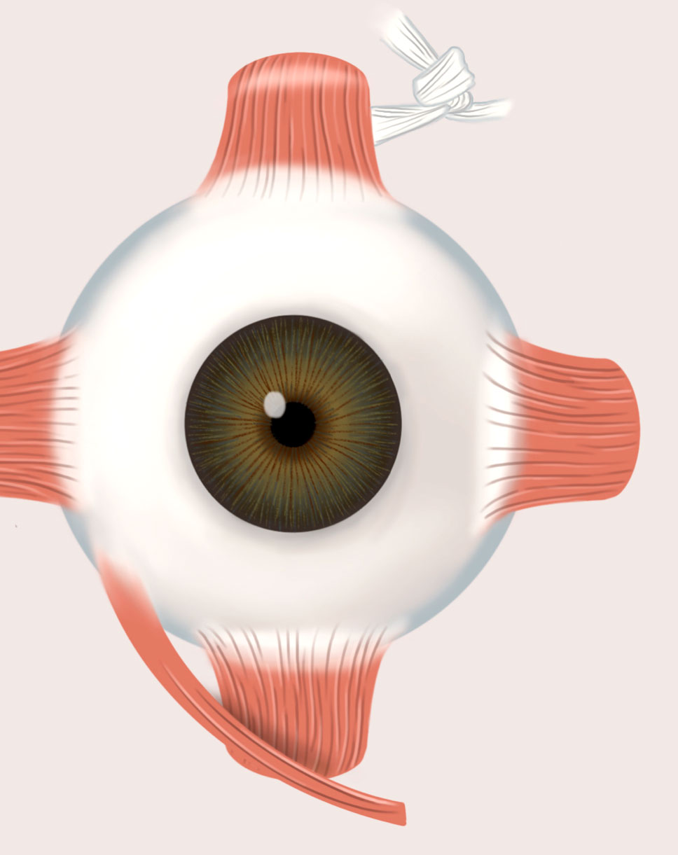 surgery-strabismus